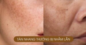 Tàn Nhang Cách Điều Trị Hiệu Quả