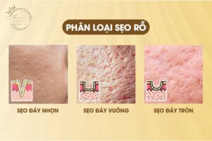 Sẹo Rỗ Là Gì?