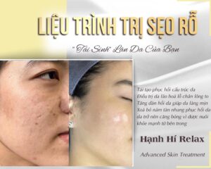 điều trị sẹo rỗ