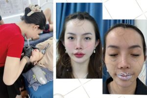 Tiêm Filler An Toàn và Chuyên Nghiệp