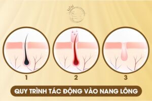 Quy trình TRIỆT LÔNG