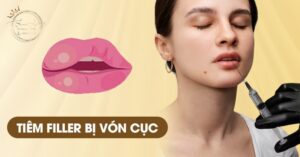 Tiêm filler bị vón cục có sao không?