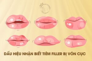 Dấu hiệu nhận biết tiêm filler bị vón cục ở môi
