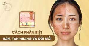 Cách Phân Biệt Nám, Tàn Nhang Và Đồi Mồi