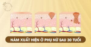 Nám xuất hiện ở phụ nữ sau 30 tuổi, đặc biệt phụ nữ mang thai, phụ nữ sau sinh, giai đoạn tiền mãn kinh hoặc có thể liên quan đến di truyền.